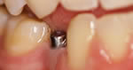 implant